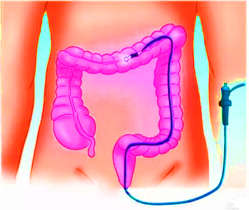 直腸癌早期有哪些癥狀？